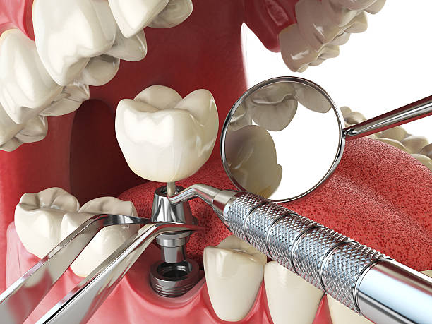 Best Emergency Treatment for Toothache in Chattahoochee Hills, GA